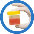 hematuria