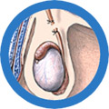 vasectomia